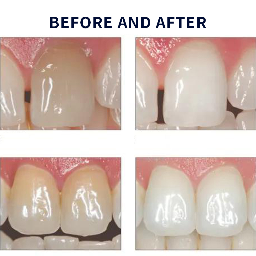 Opalescence Whitening 20% PF 2 - Teeth Whitening Foam ulasan dan harga
