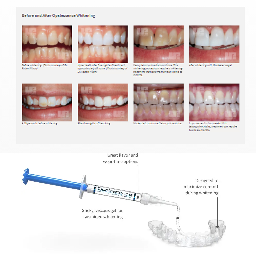 Opalescence Whitening 20% PF 2 - Teeth Whitening Foam ulasan dan harga
