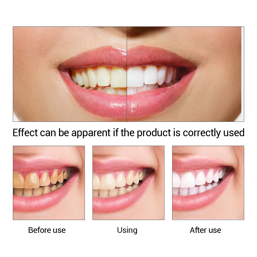 FTEENPLY Teeth Whitening Essen - Teeth Whitening Levels ulasan dan harga