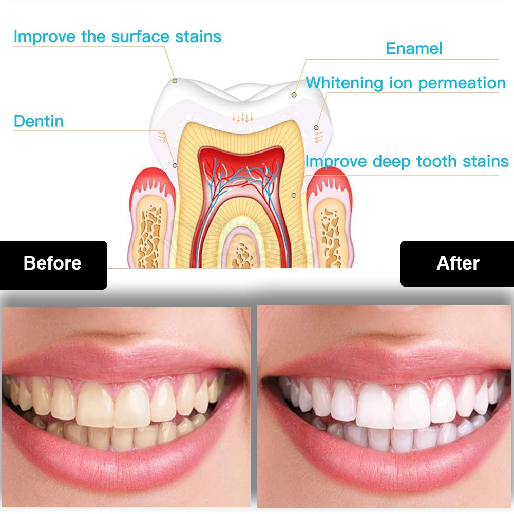 Dental Teeth Whitening Kit Min - Teeth Whitening Foam ulasan dan harga